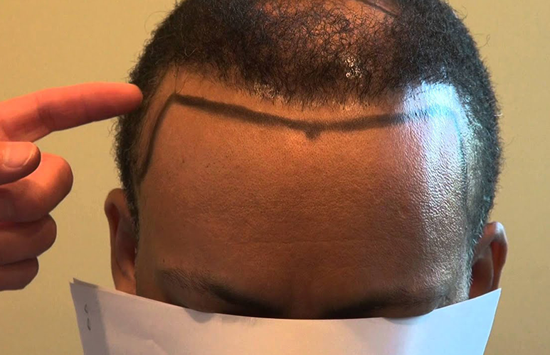 Make Sure You Have The Best Hairline In 3 Steps | Momeste Clinic